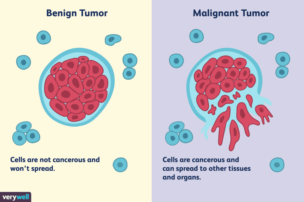 Lump Disease: Understanding the Formation, Types, Disadvantages, and Management 3 514240 article img malignant vs benign tumor2111891f 54cc 47aa 8967 4cd5411fdb2f 5a2848f122fa3a0037c544be