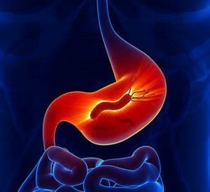 "Understanding Ulcer Disease: Causes, Risks, and Effective Treatments" 2 OIP 2024 10 19T040344.117
