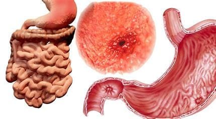 "Understanding Ulcer Disease: Causes, Risks, and Effective Treatments" 4 OIP 2024 10 19T041020.245