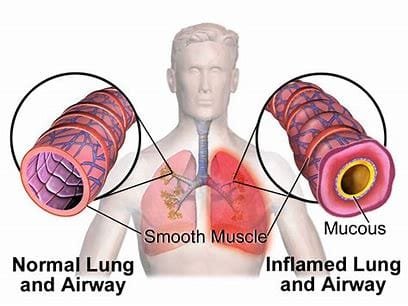 Acute Bronchitis: An Overview 4 OIP 2024 10 24T105725.593