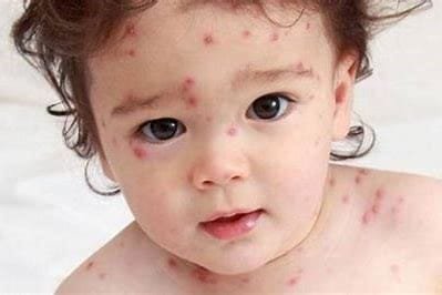Smallpox Disease in Children: Symptoms, Side Effects, and Treatment 2 OIP 2024 10 26T202701.063