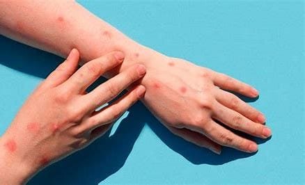 Smallpox Disease in Children: Symptoms, Side Effects, and Treatment 3 OIP 2024 10 26T202706.488