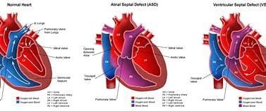 "Heart Disease and the Lifesaving Impact of Bypass Surgery: 2 OIP 2024 10 27T231039.682