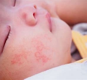 Skin Allergies in Children: Overview 4 OIP 63