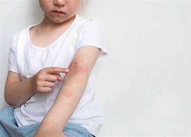 Skin Allergies in Children: Overview 2 OIP 64