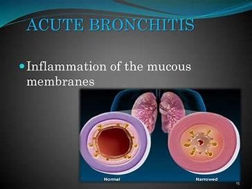Acute Bronchitis: An Overview 2 download 2024 10 24T105712.317