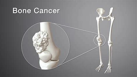 Muscle and Bone Cancer: Impact on Human Health and Medical Treatment 4 download 2024 10 27T082454.666