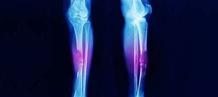 Muscle and Bone Cancer: Impact on Human Health and Medical Treatment 2 download 2024 10 27T082604.855