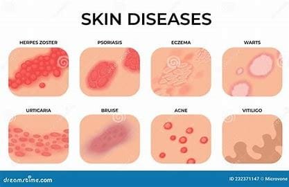 "Skin Diseases: Types, Causes, Symptoms, and Treatments" 2 download 2024 10 29T205845.529