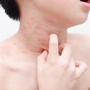 Skin Allergies in Children: Overview 3 th 36