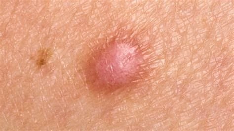 Lump Disease: Understanding the Formation, Types, Disadvantages, and Management 2 th 5