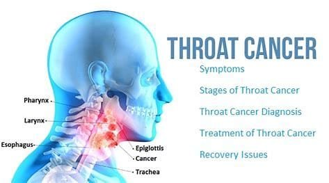 Throat cancer: causes, risks, and treatment options 3 OIP 2024 11 01T083729.355