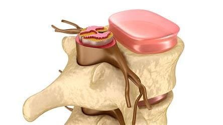 Disc Neocleoplasty: Procedure and Benefits 4 OIP 2024 11 03T073103.708 1