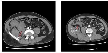 Disc Neocleoplasty: Procedure and Benefits 2 OIP 2024 11 03T073127.372