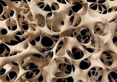 "Osteoporosis: Causes, Symptoms, and Best Treatments" 3 download 2024 11 01T043316.309