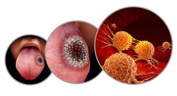 "Understanding Mouth Cancer: Symptoms, Causes, and Treatments" 2 istockphoto 1196612456 612x612 1