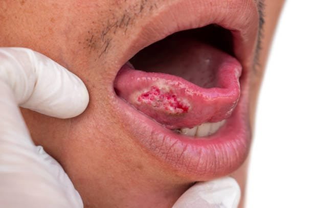 "Understanding Mouth Cancer: Symptoms, Causes, and Treatments" 4 istockphoto 1448260595 612x612 1