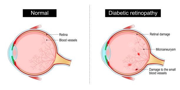 Blindness: What Causes It, Its Signs, and Other Contributing Factors. 2 istockphoto 2158899367 612x612 1