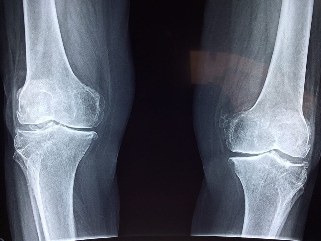 "Understanding Arthritis: Causes, Symptoms, Treatment Options, and Side Effects" 2 knee 2253047 1280