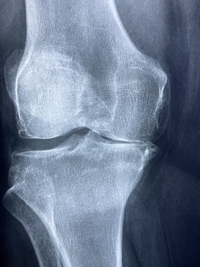 "Understanding Arthritis: Causes, Symptoms, Treatment Options, and Side Effects" 3 knee 5314881 1280 1